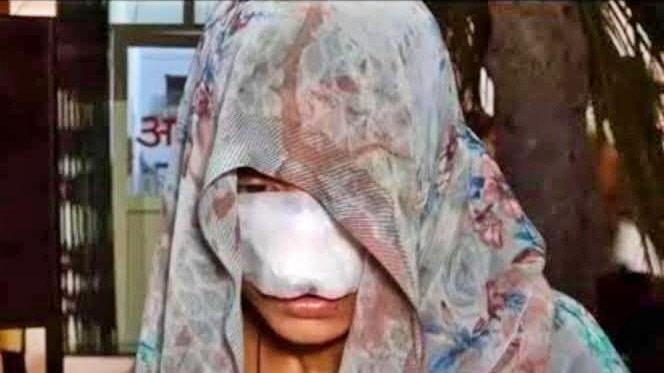 पति ने दांतों से चबा डाली पत्नी की नाक, गाल भी काटा, 10 टांके लगे