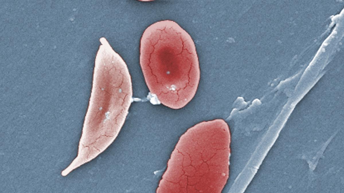Health Ministry to launch revised Anaemia Mukt Bharat guidelines